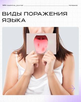 Пять видов поражения языка: диагностика без ошибок.